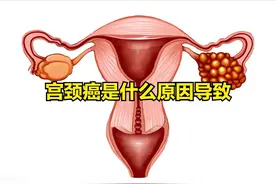 宫颈癌是什么原因导致图片