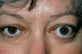 医生调查300名甲亢患者，结果发现：患甲亢的人，大多有这4个习惯图片