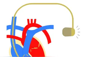 人工心脏起搏器常见的6个问题及答案，分享给您，建议收藏！图片