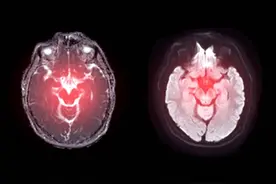 突发脑出血一般什么原因引起的？图片