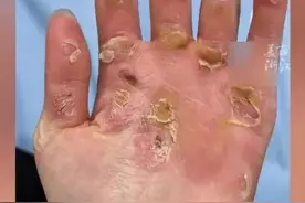 赛艇选手邹佳琪的双手看了让人心疼！图片