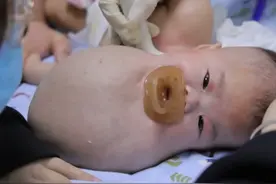 流产没流掉的畸形婴儿，顽强的生命力感动父母和医生图片