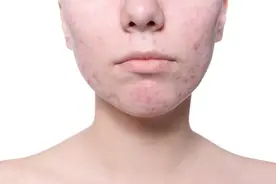 脸上痘痘太严重？看这里！教你怎么办图片