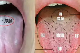嗓子里有东西又咳不出来，莫名其妙有淤青，小心“痰淤互结”体质图片