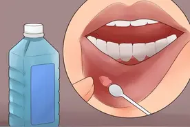 口腔溃疡是癌症？医生提醒：这4种口腔溃疡要警惕！小心患癌症图片