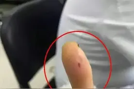 太黑心了！女子筷子倒刺扎到手指就医收费1万7，涉事医院回应！图片