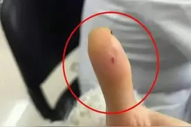 太黑心了！女子筷子倒刺扎到手指就医收费1万7，涉事医院回应！图片