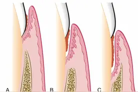一种让牙齿容易脱落的病 出现这些症状要注意图片