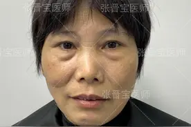 50岁用一个月“房租”，在外地做了眼袋手术，术后8天成了这样图片