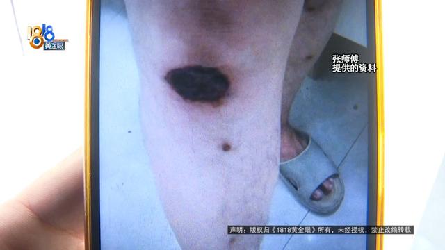 路上摔跤休息了几天，结果被“冷冻”了？