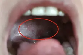 孩子发热、嗓子疼，警惕这两种疾病——图片