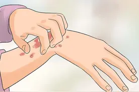 如何辨别艾滋皮疹图片