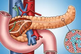 糖友胰岛一天一天在衰竭，4招可挽救图片