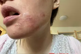 女子称用了这种护肤品后，脸黑如“包公”！商家回应图片