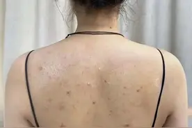 这三个除螨沐浴露祛痘太牛了！再顽固的痘痘，洗一洗就消失！图片