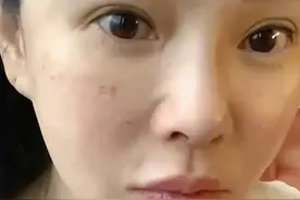 56岁伊能静跑去韩国打水光！素颜出镜，满脸针眼，并坦言真的很痛图片