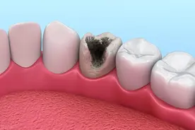 一吃东西牙齿就酸痛，千万不要忍！当心发展为慢性牙病！图片