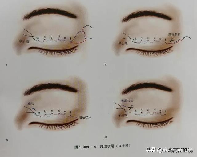 想做双眼皮?请查收这份攻略