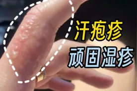 奇痒无比！夏季手脚爱长的“小水泡”，会不会传染？如何对付？图片