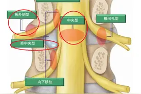 都是得腰椎间盘突出，为啥我的腰腿疼特别严重，别人的却不太疼？图片