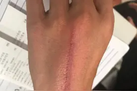 皮肤莫名红斑加疼痛！端午出游，警惕隐翅虫皮炎图片