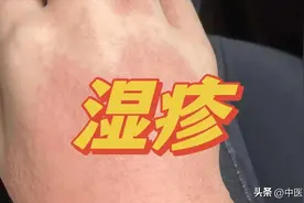 湿疹根本不用多花钱，对症喝5汤，湿疹瘙痒脱屑，一天比一天轻！图片