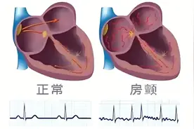 “科技之春”之三院讲堂 | 心脏乱跳？警惕这个“隐形杀手”，中风风险暴增5倍！图片