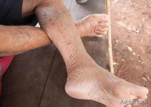 高血压与穿袜子有关？医生强调：穿袜子时，要多留意这3点！