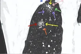 我一直说多发结节相对要保守，但今天这个却直接切了肺叶，缘何？图片