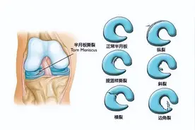 半月板撕裂别流泪，眼泪擦干看这里！图片
