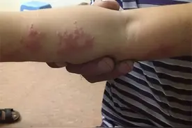 人如果感染艾滋病，多长时间会被发现？不要误以为是皮肤病图片