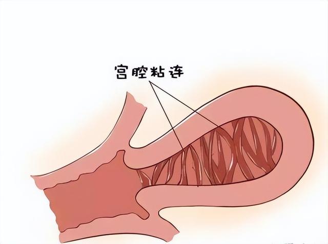 25-35岁女性反复人流，小心宫腔粘连，出现6类症状，及时就医
