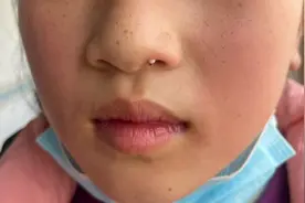 女子鼻子长疙瘩以为是黑头，医生一眼看出不对劲：是癌图片