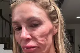 女星莫名毁容，被嘲讽整容失败。医生诊断被寄生虫“吃”掉了脸？图片