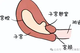 子宫憩室不规则出血，两大治疗方法解决图片