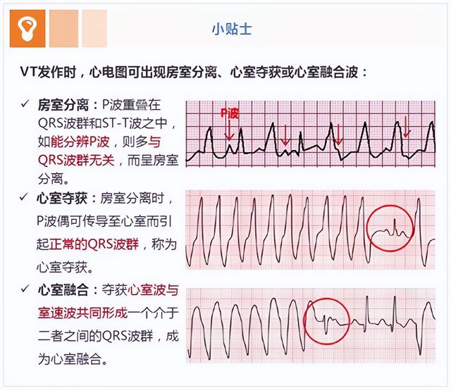 室性心动过速的体表心电图鉴别诊断