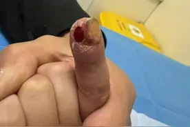 手指差点被自己啃没了！男孩咬手指肿痛二十余天，就医确诊骨髓炎图片