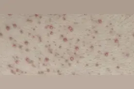 近期高发！这种小红疙瘩奇痒难耐，很多人却错把它当痘痘治，白白遭罪图片