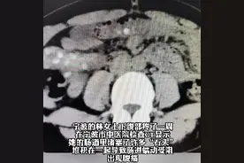 女子每天吃好多蓝莓竟然吃出肠结石图片