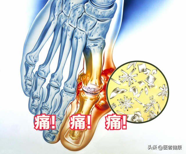 体检发现尿酸高？这6大原因很多人中招！医生教你科学应对