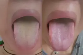 只用三步走，让舌象大变样，一清黄苔，二理气化痰，三补气血！图片