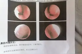 孩子总咳嗽，一检查原因竟然是腺样体肥大，是药物治疗还是手术图片