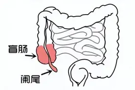 阑尾“小尾巴”，别一“炎”不合就要切！图片