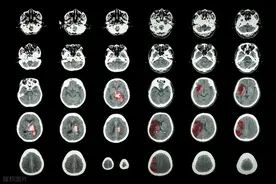 中国重症卒中管理指南2024图片