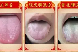 舌苔有齿痕，从生活起居、饮食及情绪心态三个方面进行调理！图片