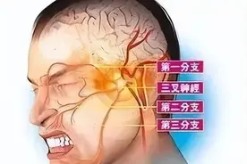 世界疼痛日——带你了解三叉神经痛图片