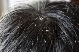 头皮屑“多如雪”，认准3种洗发水成分，和头皮屑大声“说拜拜”图片