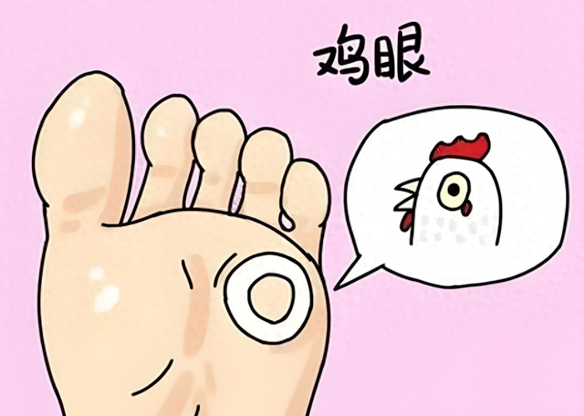 鸡眼是什么病?（什么是鸡眼）