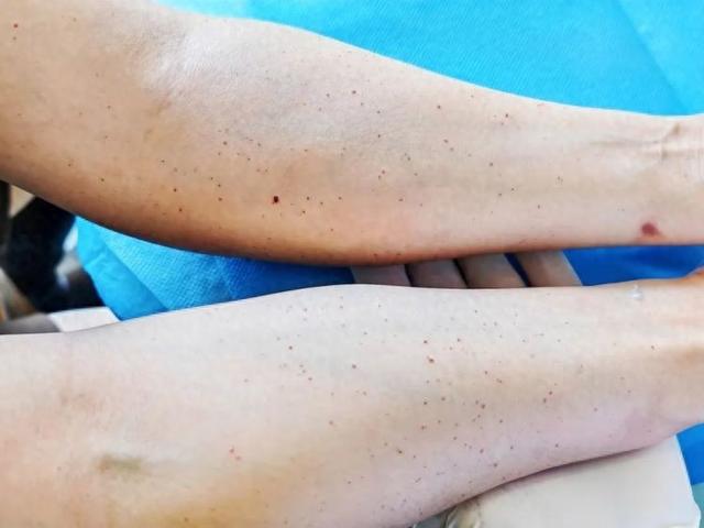 胳膊上小红点是什么.（确诊了浙江一女子手臂上都是小红点密密麻麻）