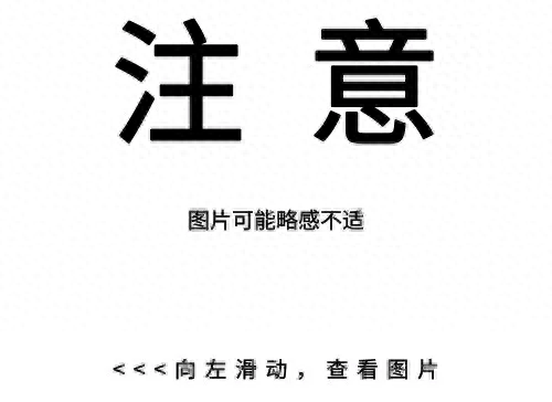 孩子睾丸鞘膜积液,能自愈吗（孩子蛋蛋变大鞘膜积液了解一下）